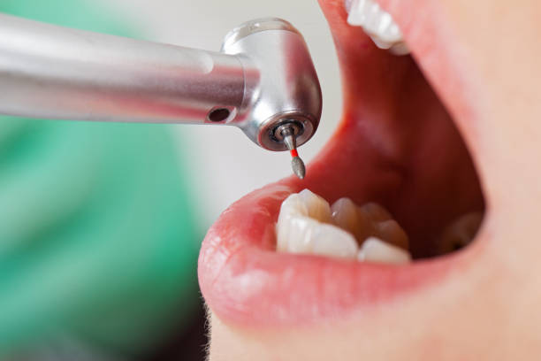 Best Emergency Wisdom Teeth Removal in North Highlands, CA